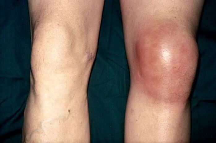 Healthy and swollen knee pain