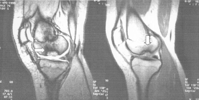 X-ray of osteochondrosis in the dissecant knee joint