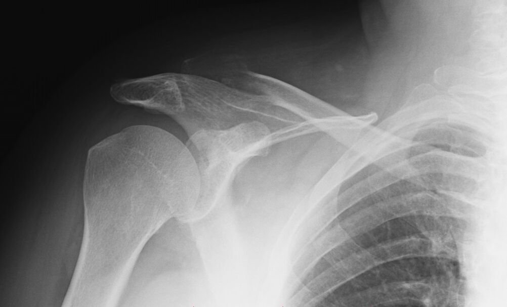 X-ray of shoulder arthrosis