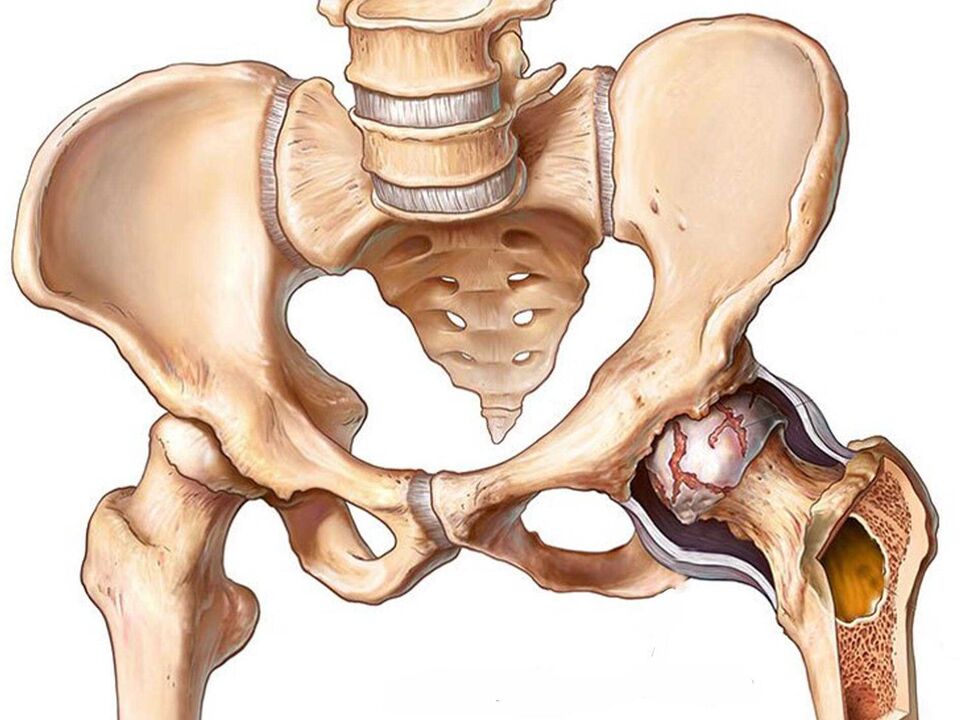 Arthrosis of the hip joint