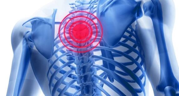 Treatment of thoracic spine osteochondrosis