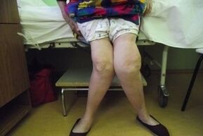 Advanced arthrosis of the knee joint