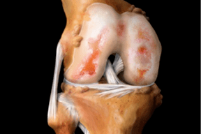 Damage to the knee joint due to arthrosis