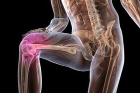 Joint pain due to knee arthrosis